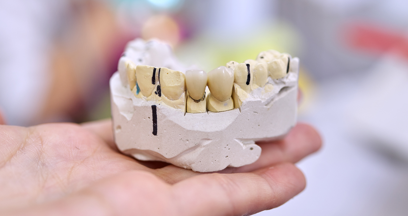 Dental Crowns and Bridges Treatment in Madipakkam
