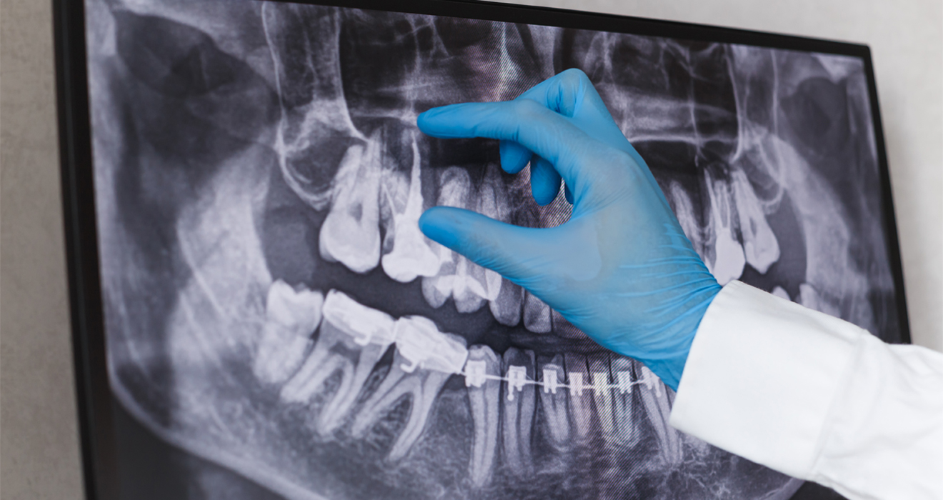 Root Canal Treatment in Madipakkam